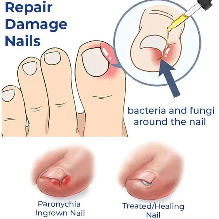 Anti-Paronychia Relief Oil  (BUY 1 GET 1 FREE).