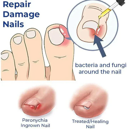 Anti-Paronychia Relief Oil  (BUY 1 GET 1 FREE).