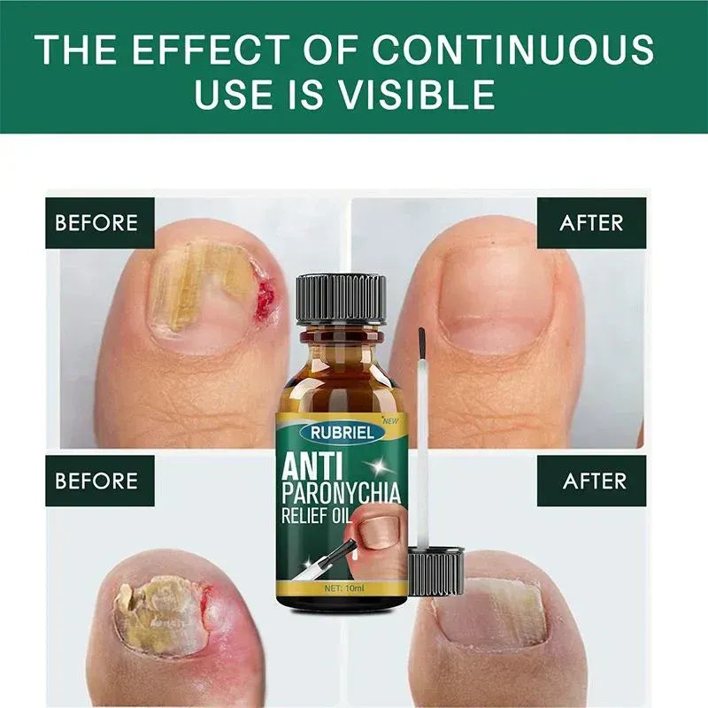 Anti-Paronychia Relief Oil  (BUY 1 GET 1 FREE).