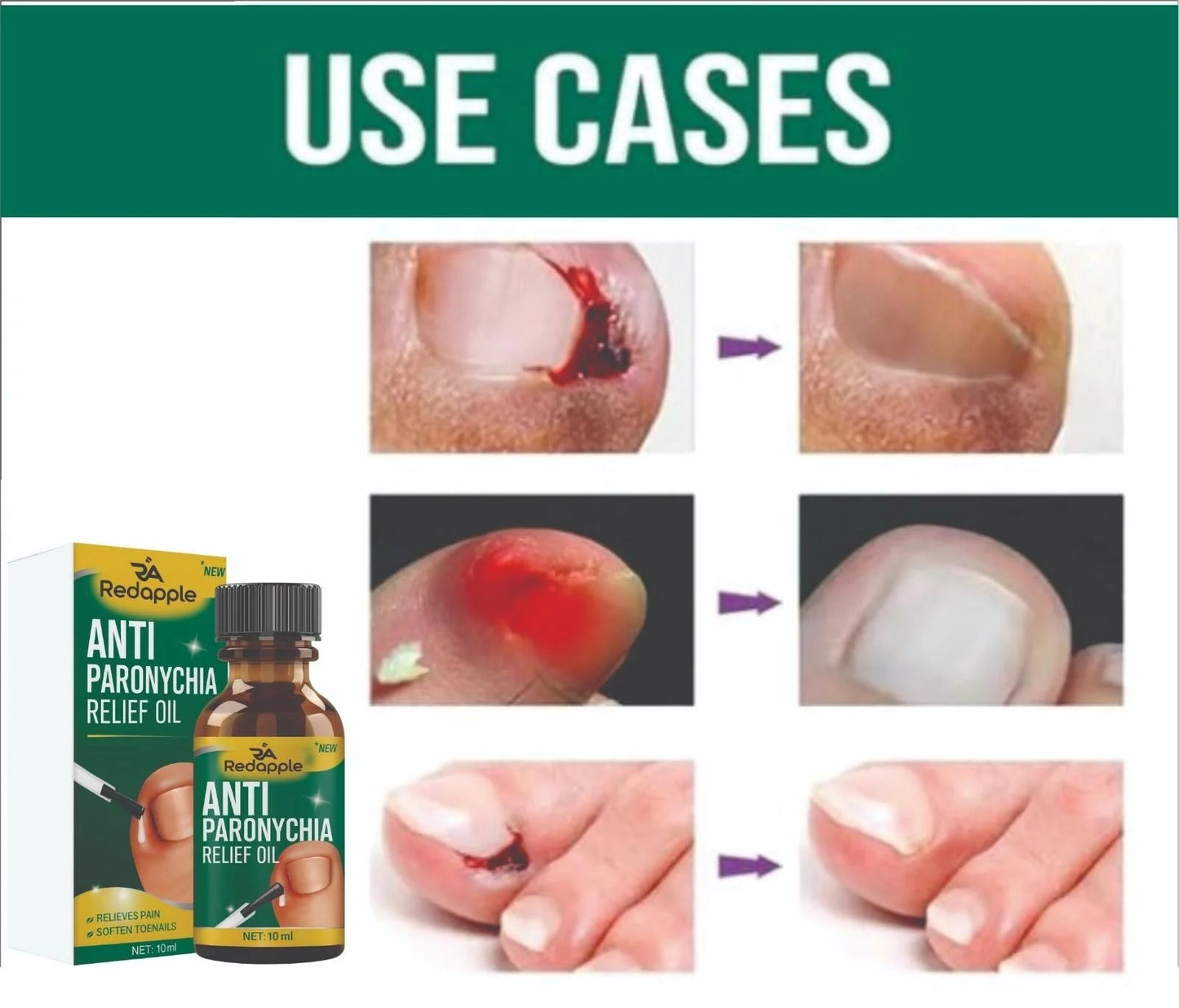 Anti-Paronychia Relief Oil  (BUY 1 GET 1 FREE).