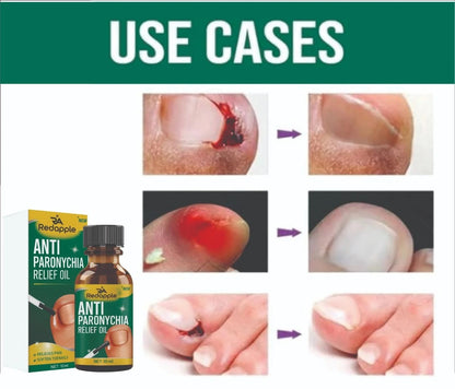Anti-Paronychia Relief Oil  (BUY 1 GET 1 FREE).